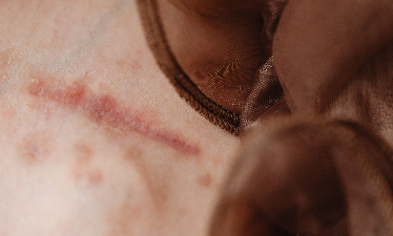 How to get rid of scars? Ways to effectively reduce scars